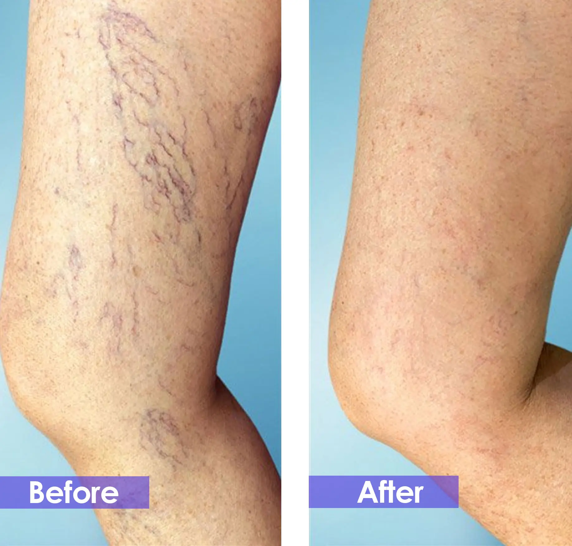 spider veins removal face